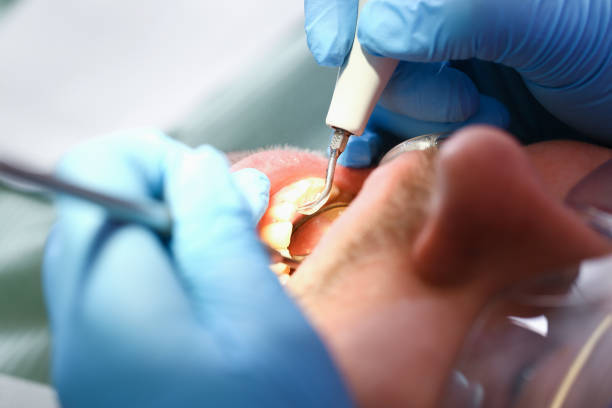 Best Emergency Wisdom Tooth Extraction in Marietta Alderwood, WA