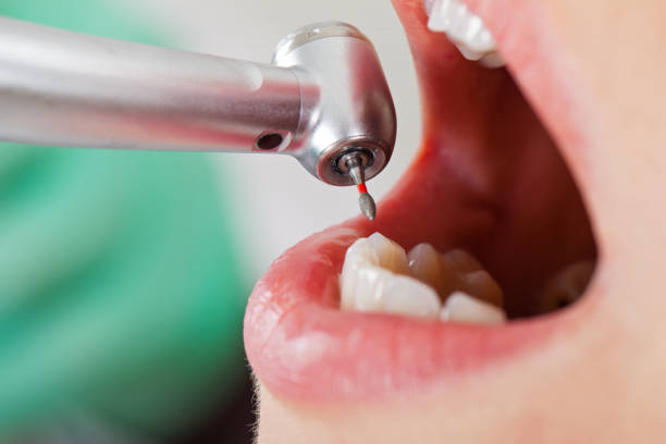 Best Emergency Denture Repair in Marietta Alderwood, WA
